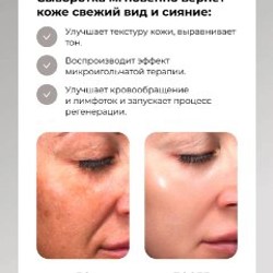 CICA Reedle Shot 700 - фото 6